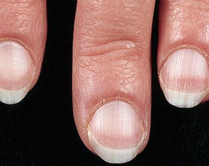 医生:指甲长期现竖纹+预示体内器官或有病变(
